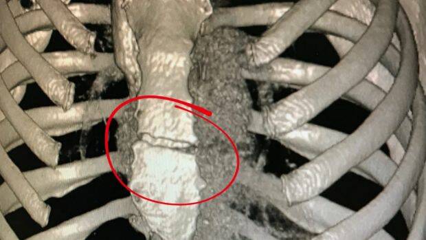 Medical images of the crack in Caroline Buchanan's sternum. Photo: Supplied

