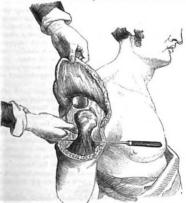 The Erichsen flap: Peter Lalor underwent the same procedure with the amputation of his left arm. Prior to removal of the arm and shoulder a flap of skin and sub-cutaneous matter was cut to cover the wound after surgery. Picture: Wiki Commons.