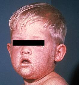 A typical measles rash