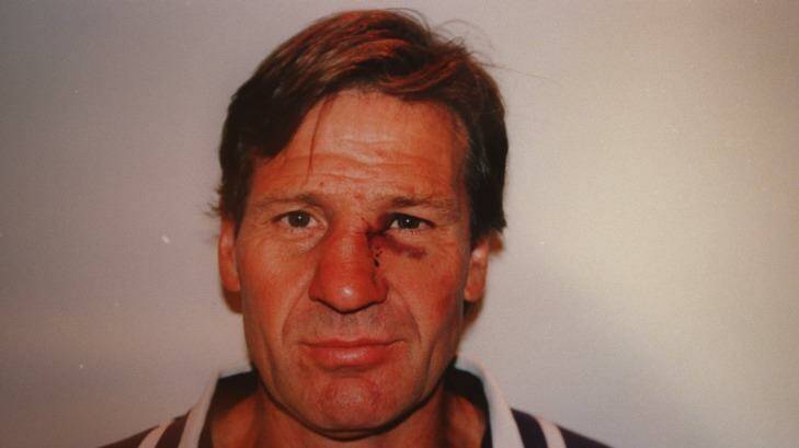 Sam Newman after he was bashed by Michael Hamill. 