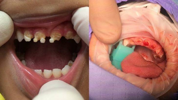 A three-year-old had 11 teeth extracted, and (right) a two-year-old was often given soft drink, which had dissolved the teeth down to the gum, exposing the nerve. 
 Photo: Supplied