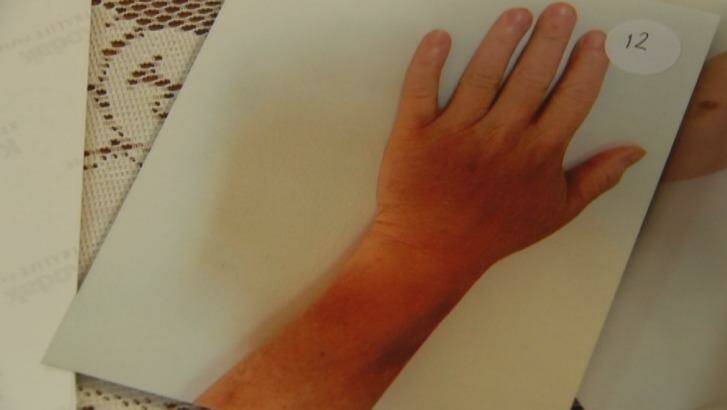 Bruising on Ms Berry's wrist. Photo: Supplied