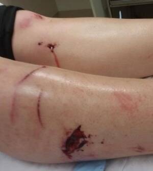 Michaela Vodvarka was bitten by a wild pig. Her leg wounds required 10 stitches. Photo: Supplied