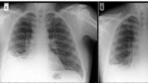 Chest X-rays of a toy cone lodged in the lower zone of a man's right lung.  Photo: Kate Aubusson
