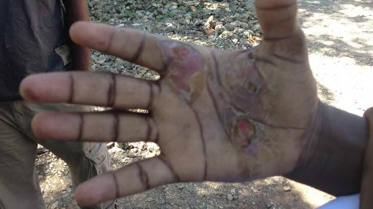 An asylum seeker says the burns on his hands were caused by Australian Navy personnel holding his hands to hot parts of a boat engine. Photo: Supplied
