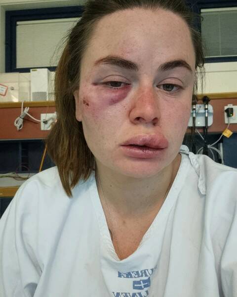 Ballarat woman Sissy Austin was attacked while running in the Lal Lal area on Saturday. Picture supplied. 