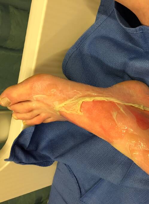 BURNS: The damaged foot.