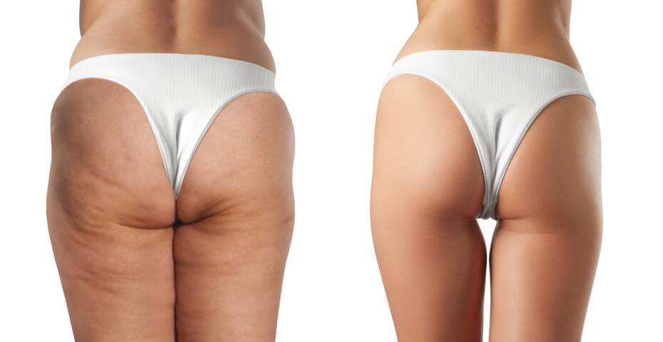 Liposuction and the popularity behind getting the procedure