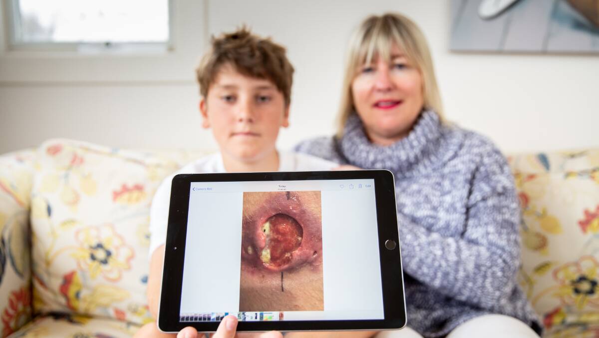 Gus Charles and mum Sally show just how destructive the Buruli ulcer can be. Gus needed major surgery after catching the bacteria in Sorrento.