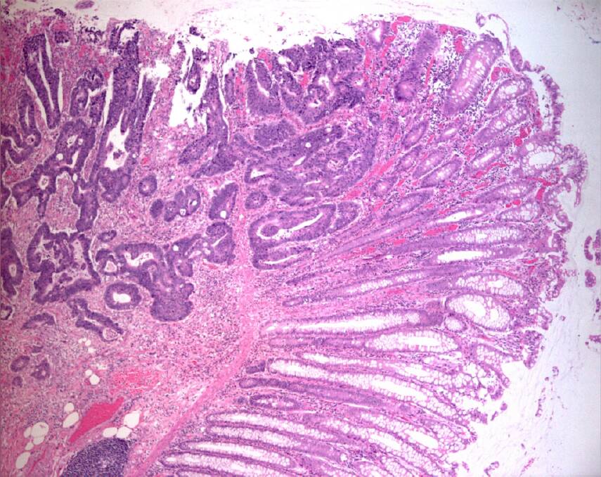 A tissue section of bowl cancer. Picture: FECRI