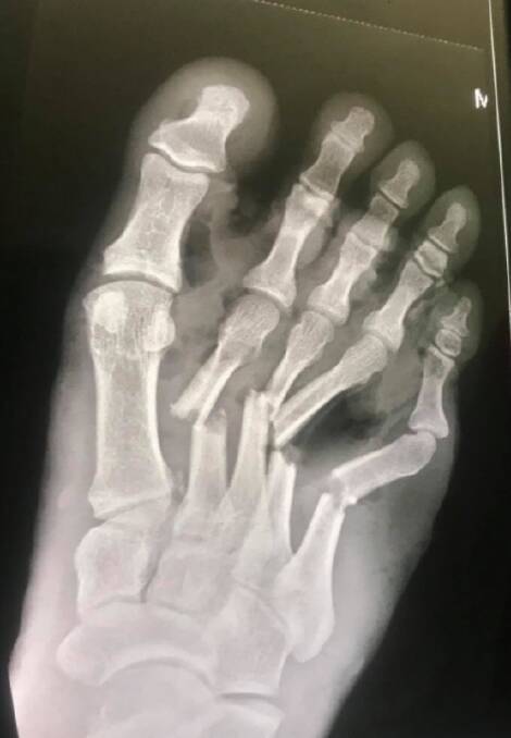 The x-ray of Jack Jones' foot.