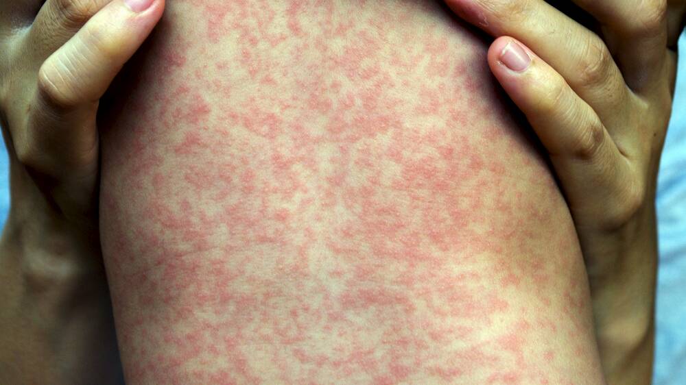 A typical measles rash
