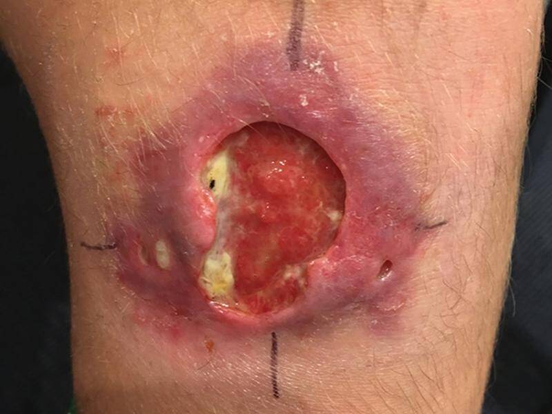 Cureus  Flesh Fly Maggot-Infected Abscess in a Burn Victim